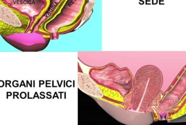 L’utero prolassato va conservato, la tecnica POPS