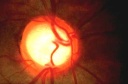 Chirurgia del glaucoma: due complessi interventi eseguiti alle Scotte