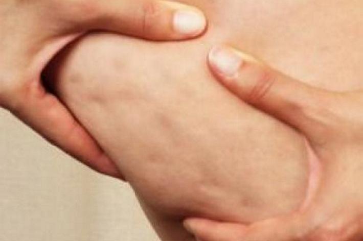 Più dell’obesità potè la cellulite, malattia moderna