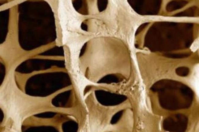 L’osteoporosi si misura in farmacia